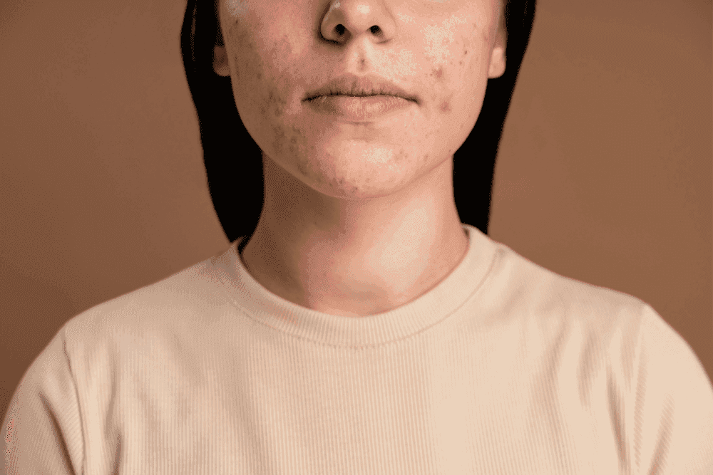 Acne e oleosidade: tratamento certo para pele livre