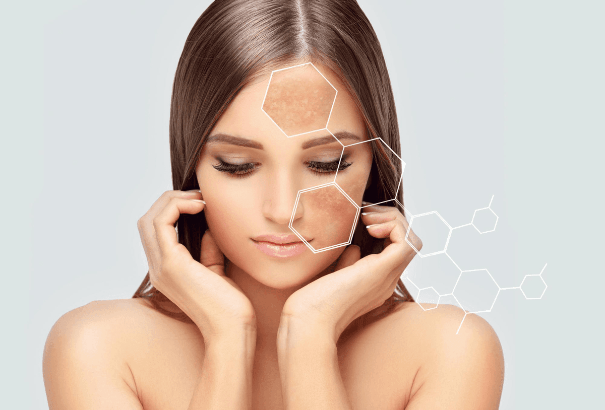 Melasma: o que é, por que aparece e como cuidar do seu jeito